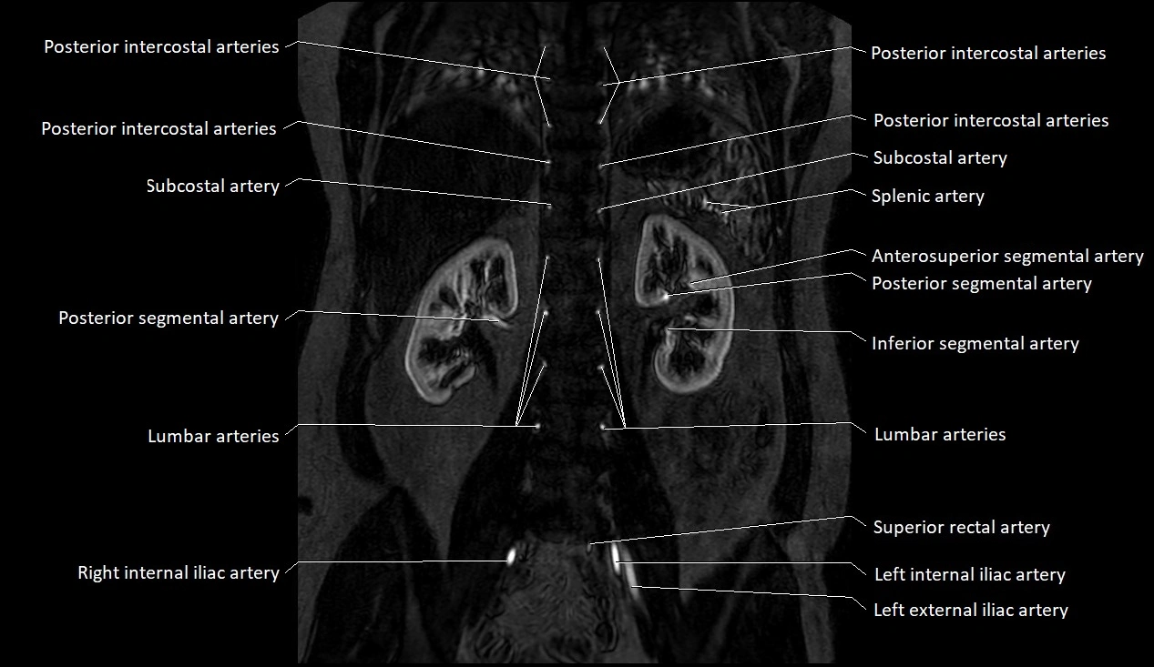 MRA Abdomen coronal anatomy image 35.webp